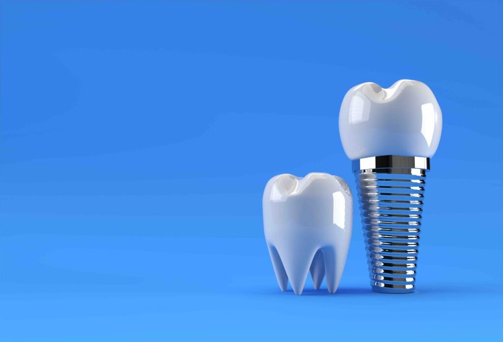 dental implant glossary Horley
