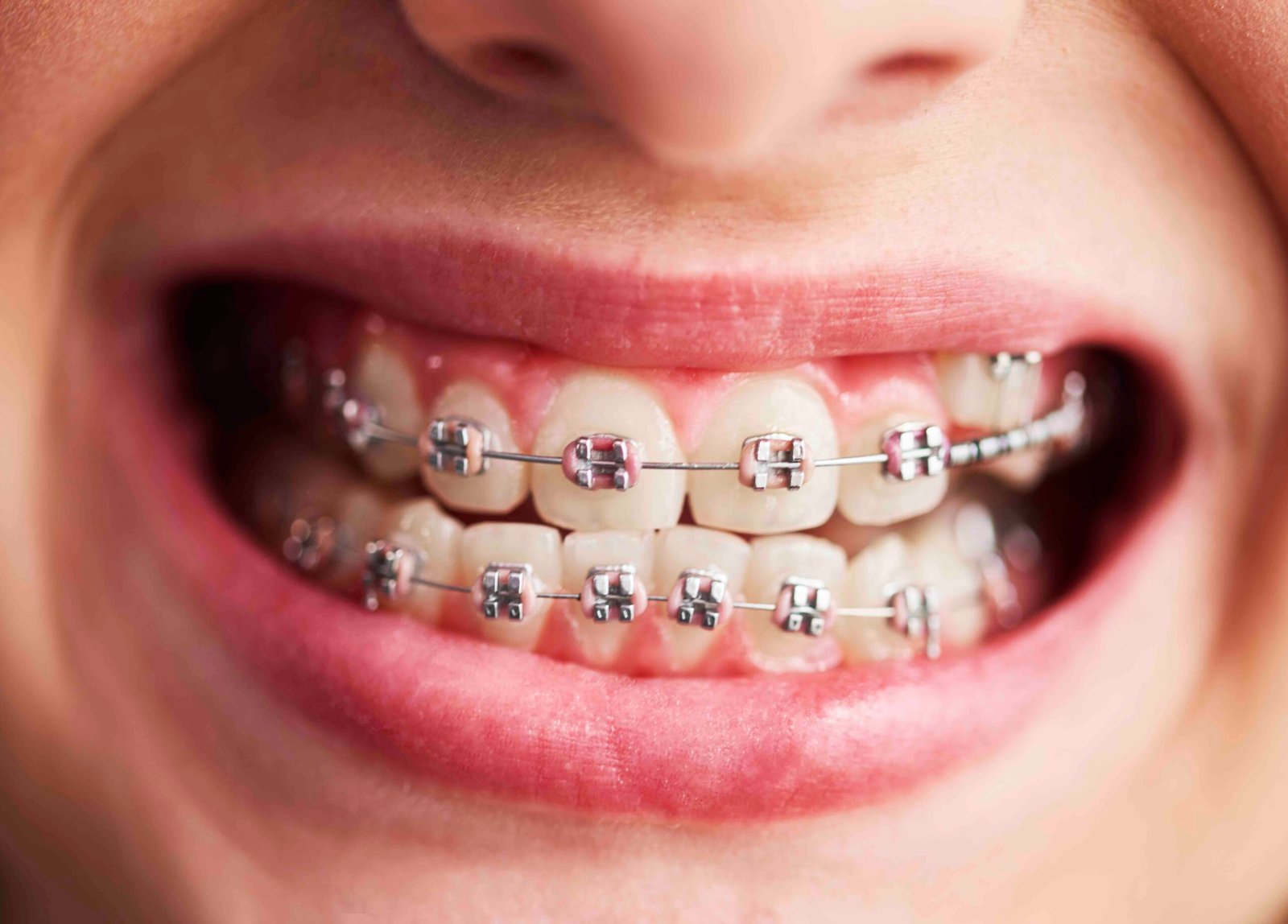 Complete Guide to Orthodontics